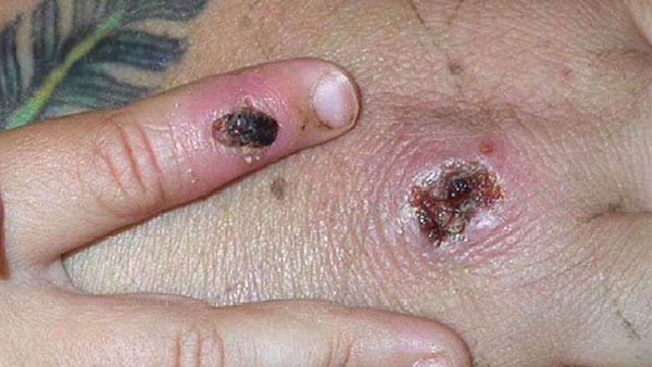 Monkeypox Detected in Growing Number of Countries, US Confirms First Case